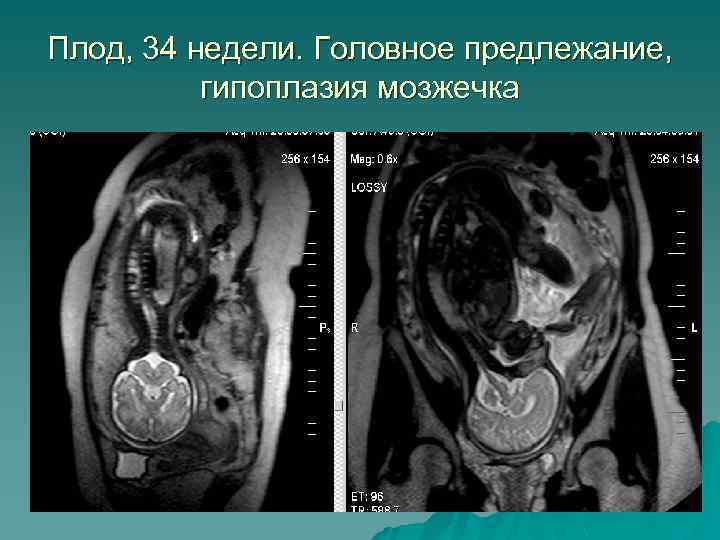 Плод, 34 недели. Головное предлежание, гипоплазия мозжечка 