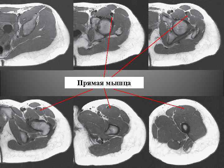 Прямая мышца 