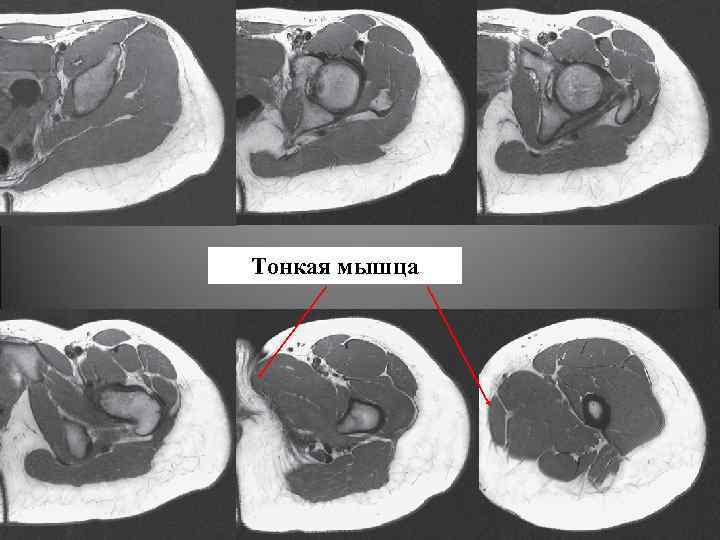 Тонкая мышца 