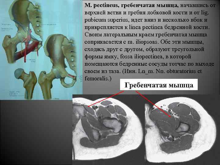 М. pectineus, гребенчатая мышца, начавшись от верхней ветви и гребня лобковой кости и от