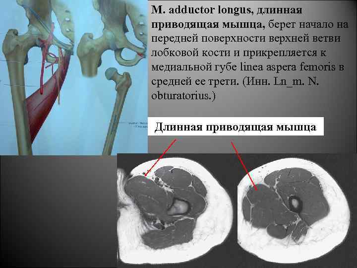 M. adductor longus, длинная приводящая мышца, берет начало на передней поверхности верхней ветви лобковой