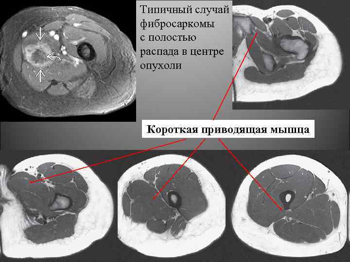 Типичный случай фибросаркомы с полостью распада в центре опухоли Короткая приводящая мышца 