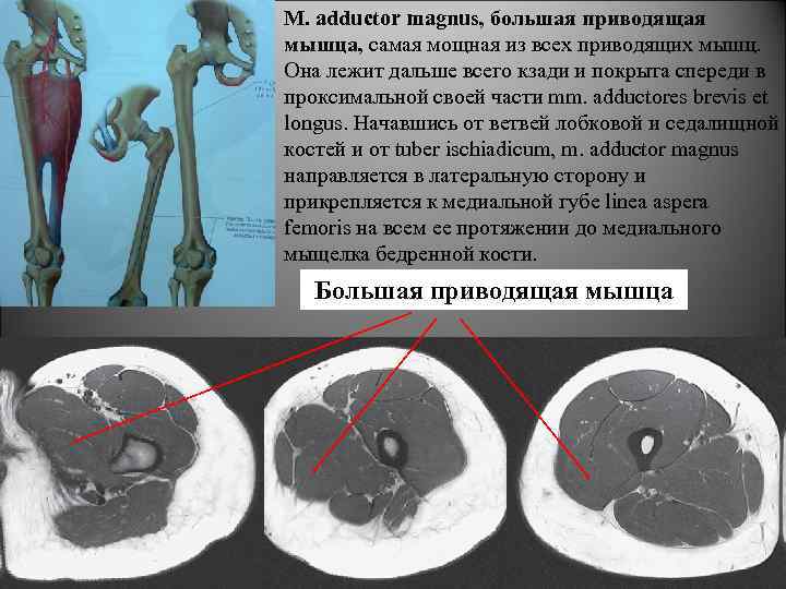 М. adductor magnus, большая приводящая мышца, самая мощная из всех приводящих мышц. Она лежит