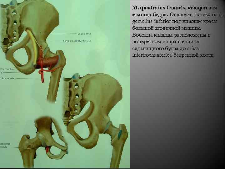 M. quadratus femoris, квадратная мышца бедра. Она лежит книзу от m. gemellus inferior под