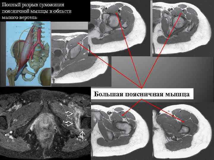 Полный разрыв сухожилия поясничной мышцы в области малого вертела Большая поясничная мышца 