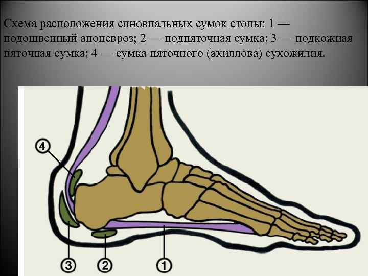 Схема расположения синовиальных сумок стопы: 1 — подошвенный апоневроз; 2 — подпяточная сумка; 3