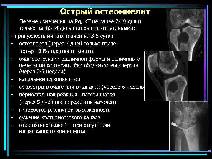 Острый остеомиелит - - - Первые изменения на Rg, КТ не ранее 7 -10