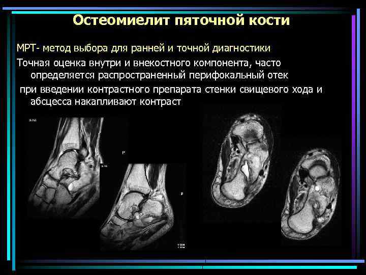 Остеомиелит пяточной кости МРТ- метод выбора для ранней и точной диагностики Точная оценка внутри