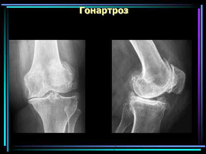 Гонартроз коленного сустава 1 степени. Гонартроз коленного сустава 1 степени на рентгене. Рентген стадии гонартроза.