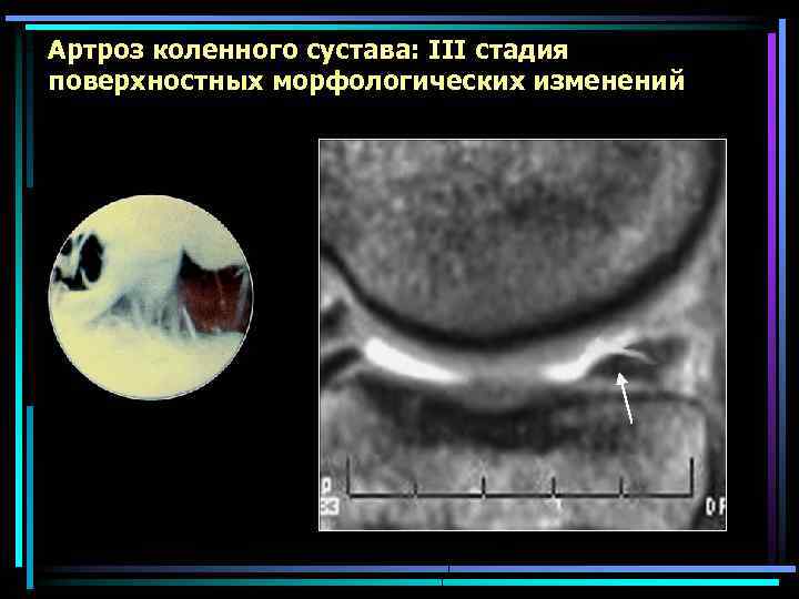 Артроз коленного сустава: III стадия поверхностных морфологических изменений 