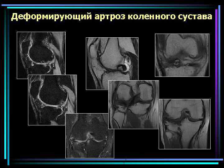 Тейпирование коленного сустава при артрозе схема фото