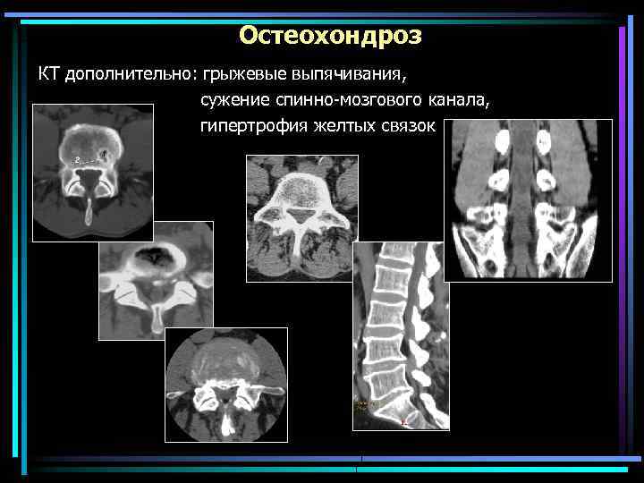 Остеохондроз КТ дополнительно: грыжевые выпячивания, сужение спинно-мозгового канала, гипертрофия желтых связок 