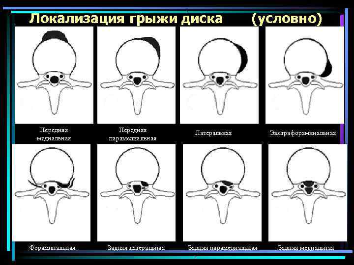 Локализация грыжи диска Передняя медиальная Фораминальная Передняя парамедиальная Задняя латеральная (условно) Латеральная Задняя парамедиальная