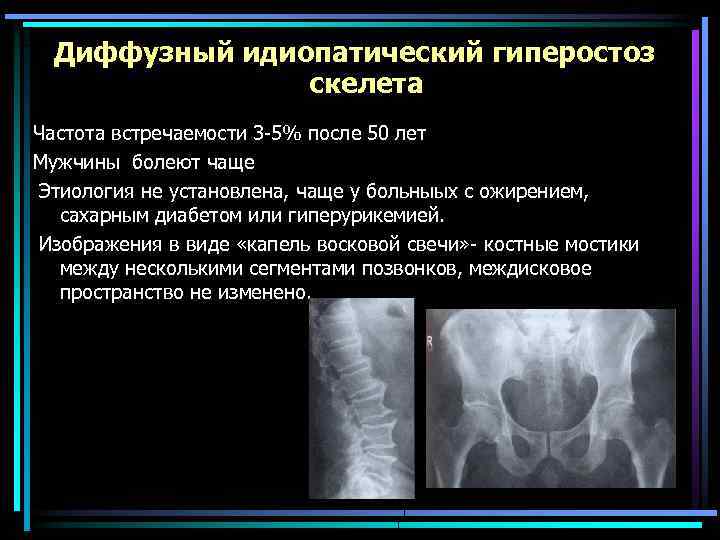 Диффузный идиопатический гиперостоз скелета Частота встречаемости 3 -5% после 50 лет Мужчины болеют чаще