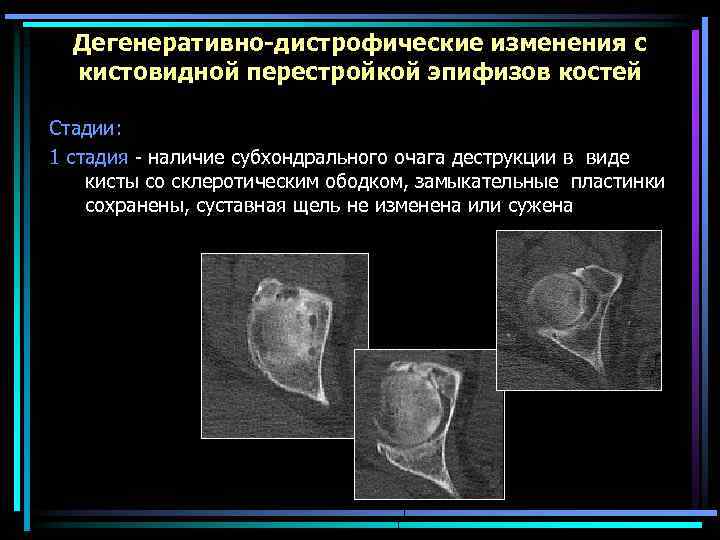 Дегенеративно-дистрофические изменения с кистовидной перестройкой эпифизов костей Стадии: 1 стадия - наличие субхондрального очага