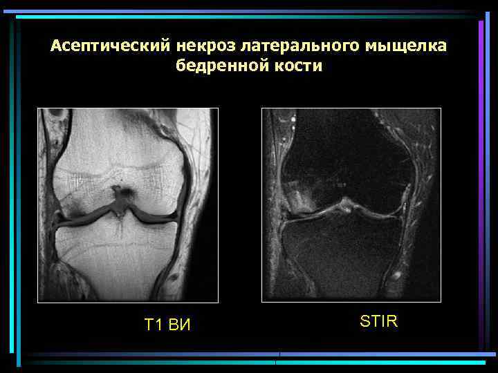 Асептический некроз латерального мыщелка бедренной кости Т 1 ВИ STIR 