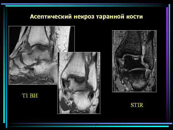 Асептический некроз таранной кости Т 1 ВИ STIR 