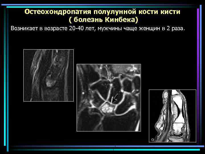 Остеохондропатия полулунной кости кисти ( болезнь Кинбека) Возникает в возрасте 20 -40 лет, мужчины