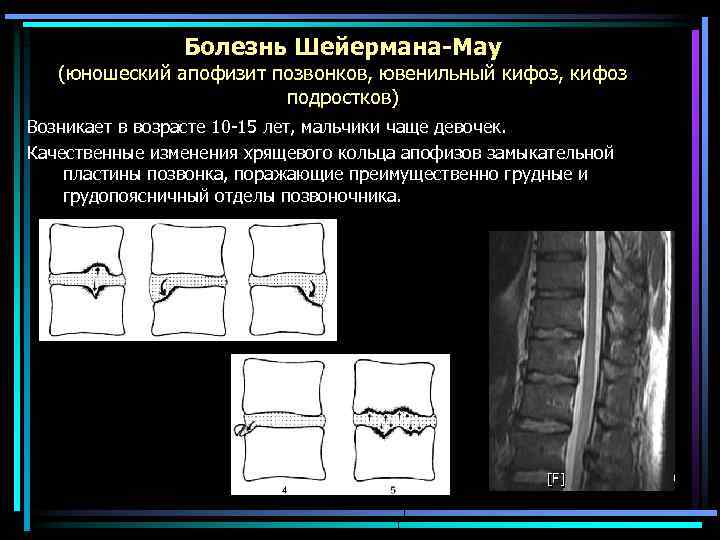 Болезнь шейермана мау. Апофиз позвонка рентген. Апофиз поясничного позвонка. Шойерман МАУ болезнь на мрт позвоночника. Остеохондропатия позвонков болезнь Шейермана-МАУ.