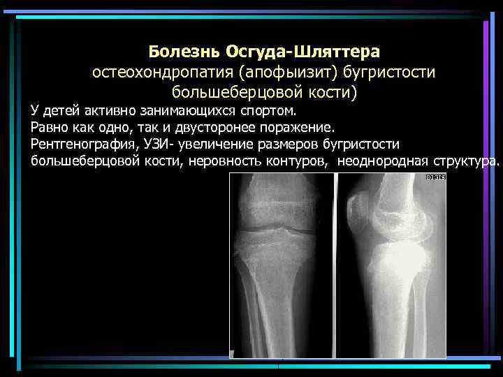 Болезнь Осгуда-Шляттера остеохондропатия (апофыизит) бугристости большеберцовой кости) У детей активно занимающихся спортом. Равно как