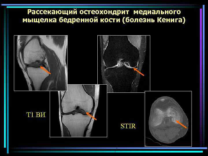 Болезнь кенига презентация