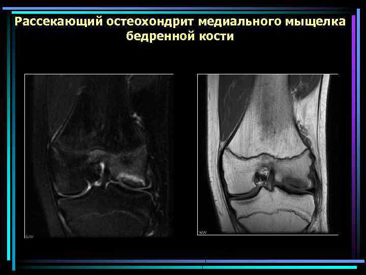 Хондромаляция бедренной и большеберцовой кости. Рассекающий остеохондрит мрт. Болезнь Кенига коленного сустава мрт. Рассекающий остеохондрит медиального. Рассекающий остеохондрит надколенника кт.