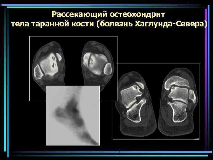 Рассекающий остеохондрит тела таранной кости (болезнь Хаглунда-Севера) 