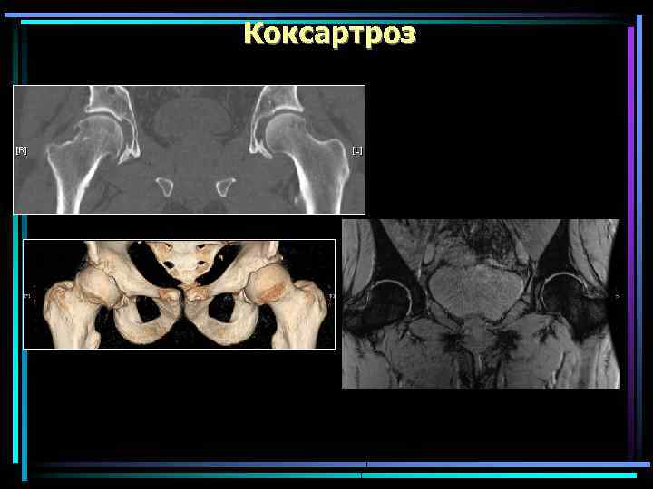 Коксартроз 