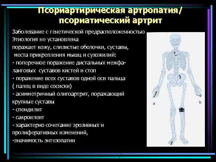 Псориартирическая артропатия/ псориатический артрит Заболевание с генетической предрасположенностью Этиология не установлена поражает кожу, слизистые