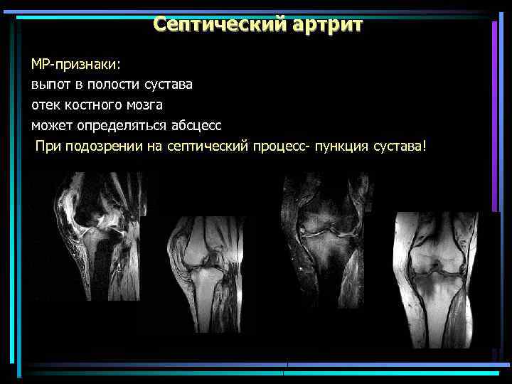 Септический артрит МР-признаки: выпот в полости сустава отек костного мозга может определяться абсцесс При