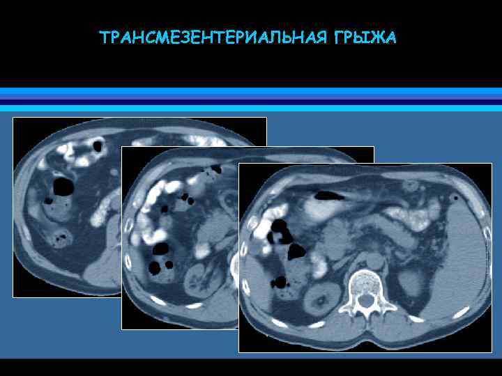 ТРАНСМЕЗЕНТЕРИАЛЬНАЯ ГРЫЖА 