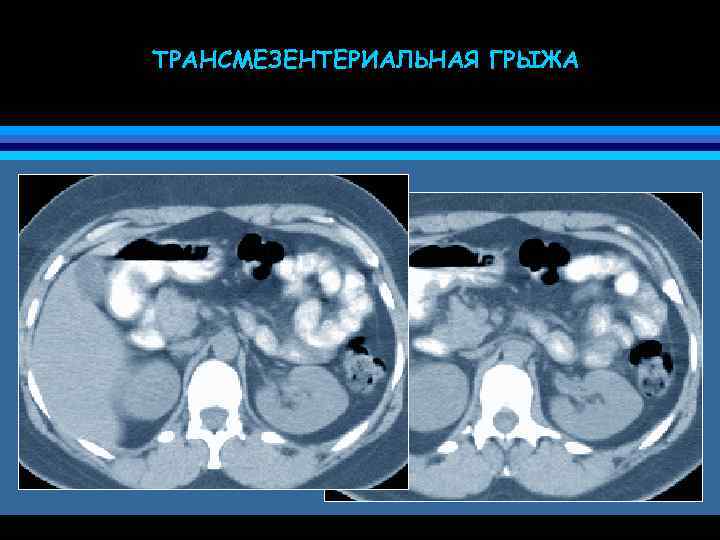 ТРАНСМЕЗЕНТЕРИАЛЬНАЯ ГРЫЖА 