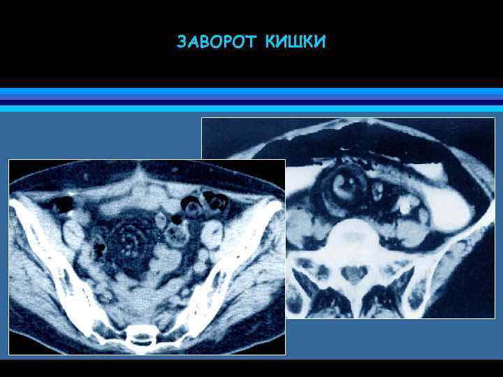 Симптомы заворота кишок. Хронический заворот Сигмы. Заворот слепой кишки кт.