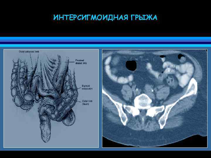 ИНТЕРСИГМОИДНАЯ ГРЫЖА 