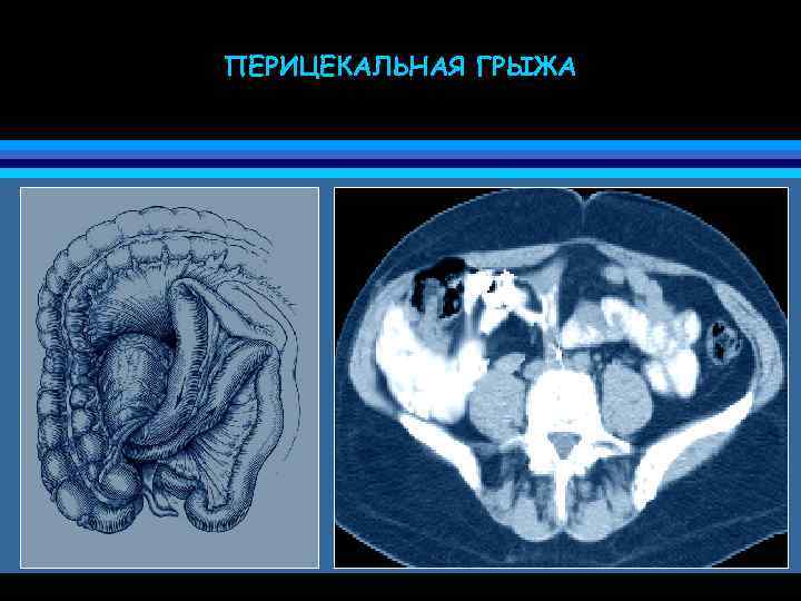 ПЕРИЦЕКАЛЬНАЯ ГРЫЖА 