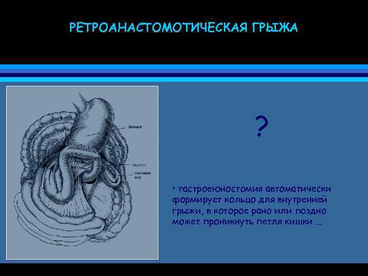 РЕТРОАНАСТОМОТИЧЕСКАЯ ГРЫЖА ? • гастроеюностомия автоматически формирует кольцо для внутренней грыжи, в которое рано