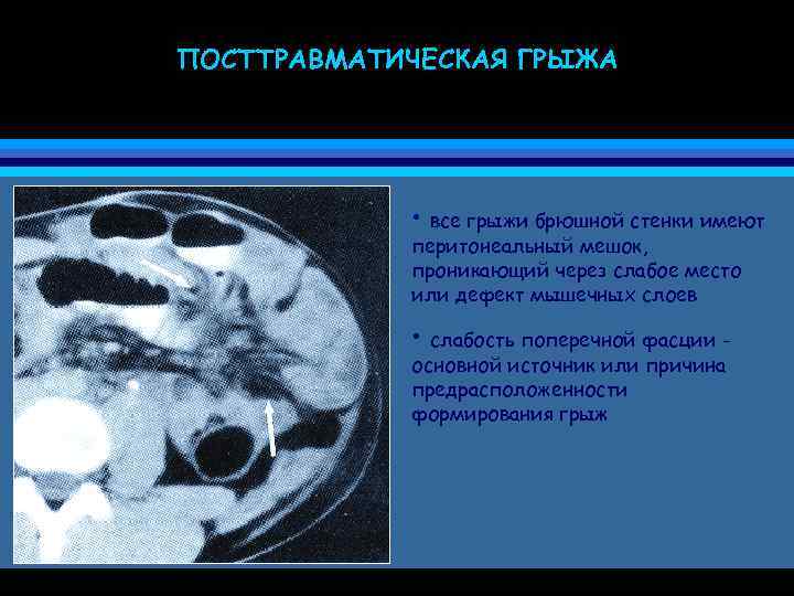 ПОСТТРАВМАТИЧЕСКАЯ ГРЫЖА • все грыжи брюшной стенки имеют перитонеальный мешок, проникающий через слабое место