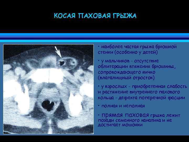 Паховая грыжа мкб. Косая паховая грыжа мрт. Паховая грыжа прямая и косая кт.