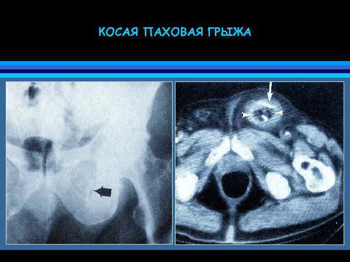 КОСАЯ ПАХОВАЯ ГРЫЖА 