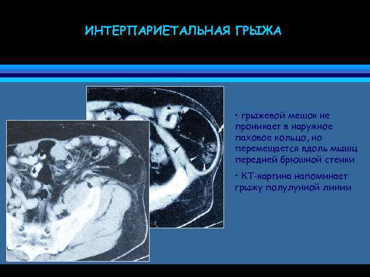 ИНТЕРПАРИЕТАЛЬНАЯ ГРЫЖА • грыжевой мешок не проникает в наружное паховое кольцо, но перемещается вдоль