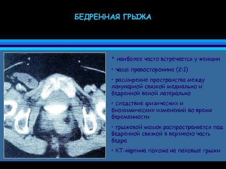БЕДРЕННАЯ ГРЫЖА • наиболее часто встречается у женщин • чаще правосторонние (2: 1) •
