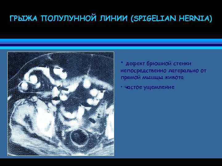 ГРЫЖА ПОЛУЛУННОЙ ЛИНИИ (SPIGELIAN HERNIA) • дефект брюшной стенки непосредственно латерально от прямой мышцы