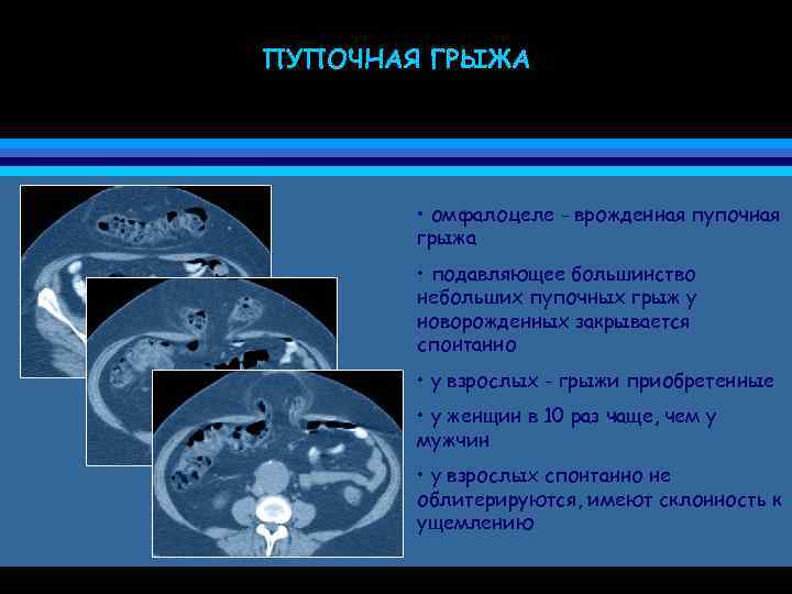 ПУПОЧНАЯ ГРЫЖА • омфалоцеле - врожденная пупочная грыжа • подавляющее большинство небольших пупочных грыж