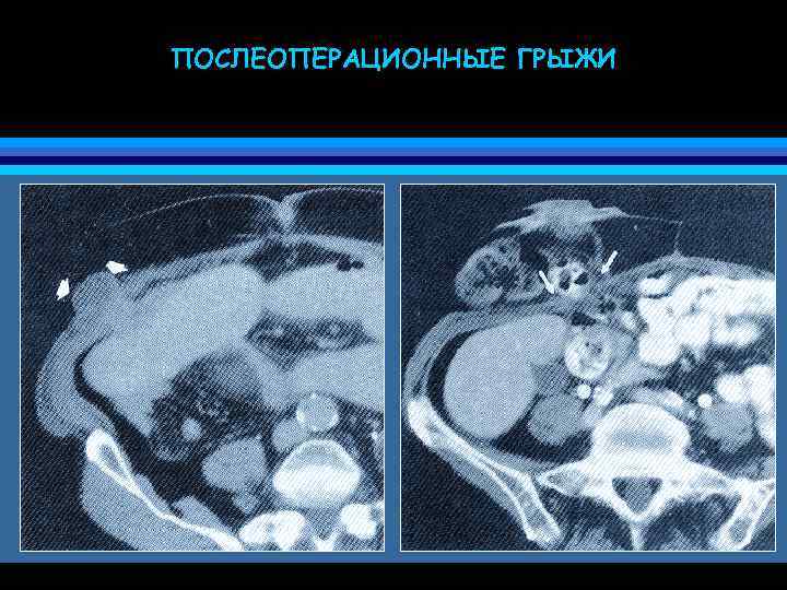ПОСЛЕОПЕРАЦИОННЫЕ ГРЫЖИ 