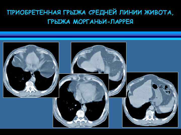 ПРИОБРЕТЕННАЯ ГРЫЖА СРЕДНЕЙ ЛИНИИ ЖИВОТА, ГРЫЖА МОРГАНЬИ-ЛАРРЕЯ 