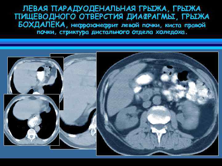 ЛЕВАЯ ПАРАДУОДЕНАЛЬНАЯ ГРЫЖА, ГРЫЖА ПИЩЕВОДНОГО ОТВЕРСТИЯ ДИАФРАГМЫ, ГРЫЖА БОХДАЛЕКА, нефрозонефрит левой почки, киста правой