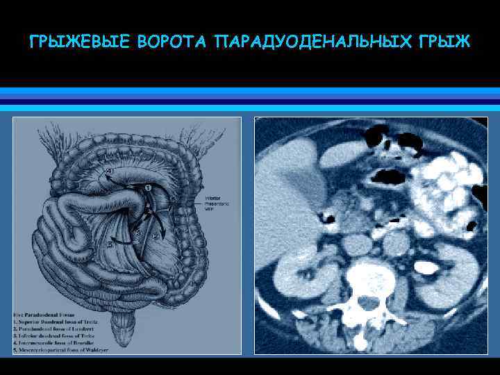 ГРЫЖЕВЫЕ ВОРОТА ПАРАДУОДЕНАЛЬНЫХ ГРЫЖ 