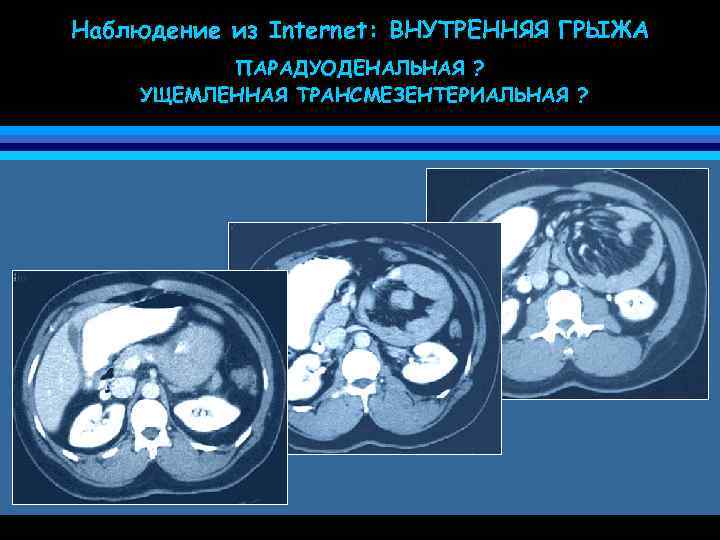 Наблюдение из Internet: ВНУТРЕННЯЯ ГРЫЖА ПАРАДУОДЕНАЛЬНАЯ ? УЩЕМЛЕННАЯ ТРАНСМЕЗЕНТЕРИАЛЬНАЯ ? 