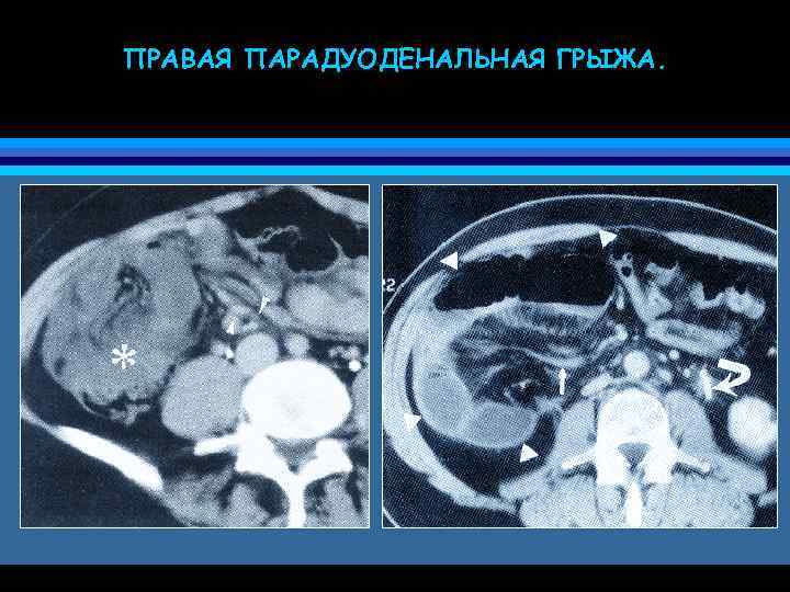 ПРАВАЯ ПАРАДУОДЕНАЛЬНАЯ ГРЫЖА. 