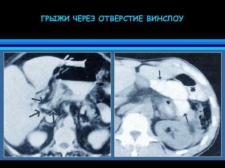 ГРЫЖИ ЧЕРЕЗ ОТВЕРСТИЕ ВИНСЛОУ 
